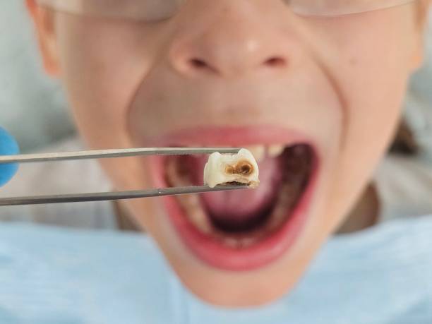 Best Emergency Wisdom Teeth Removal in Gra Forks, ND